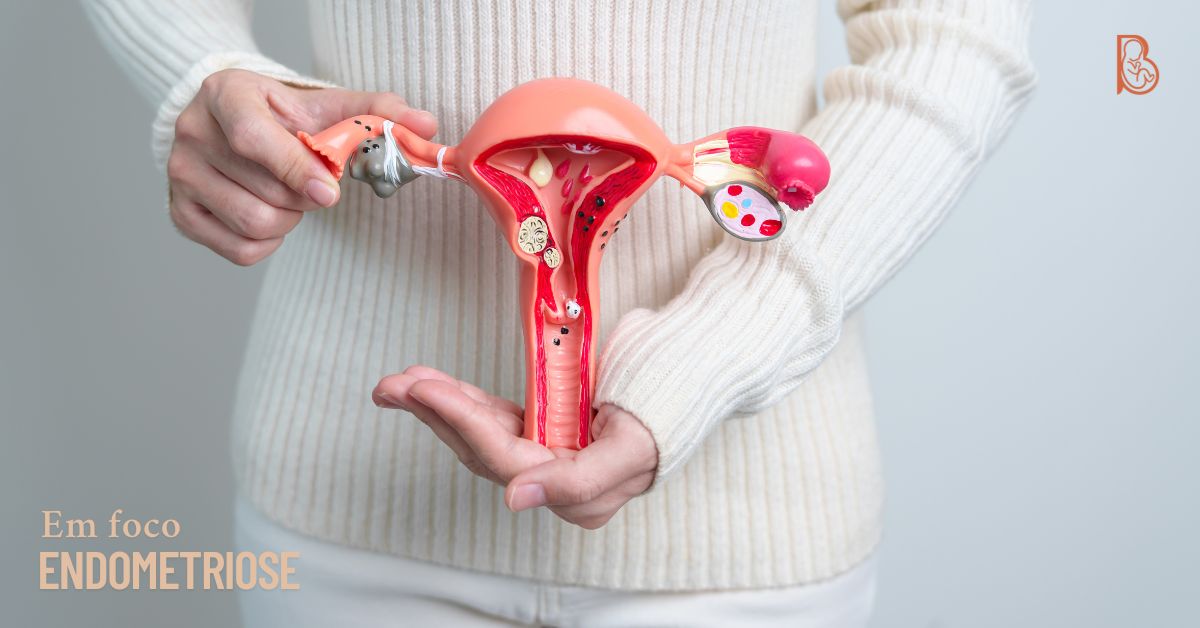 Endometriose em foco: como identificar sintomas e buscar tratamento com uma ginecologista em Copacabana
